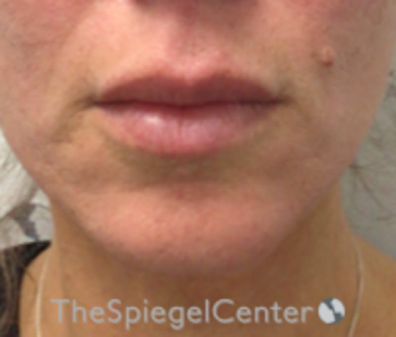 Lip Filler Before & After Gallery - Patient 262042 - Image 2