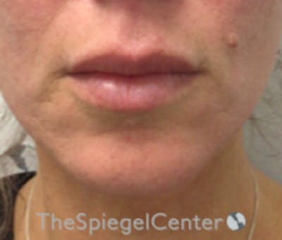 Lip Filler Before & After Gallery - Patient 262042 - Image 2