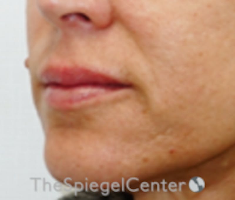 Lip Filler Before & After Gallery - Patient 262042 - Image 3
