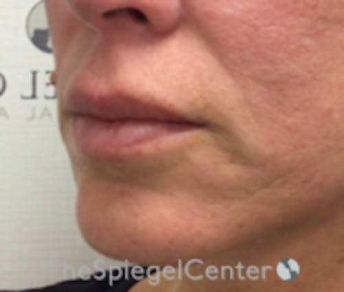 Lip Filler Before & After Gallery - Patient 262042 - Image 4