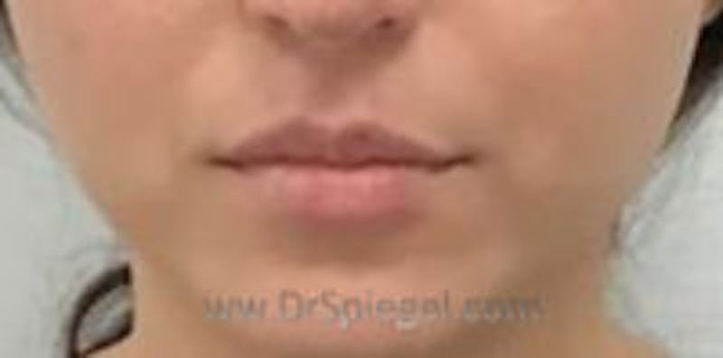 Lip Filler Before & After Gallery - Patient 157309 - Image 2