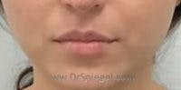 Lip Filler Before & After Gallery - Patient 157309 - Image 2