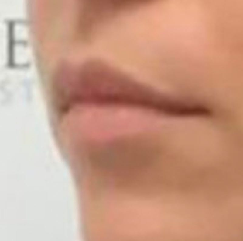 Lip Filler Before & After Gallery - Patient 157309 - Image 3
