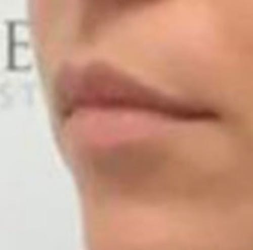 Lip Filler Before & After Gallery - Patient 157309 - Image 3