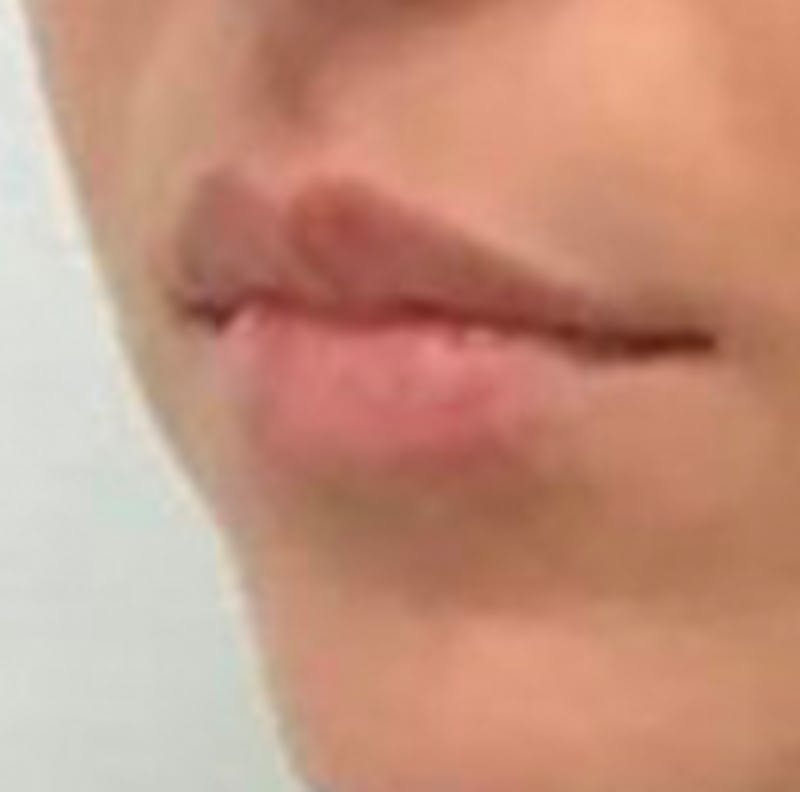 Lip Filler Before & After Gallery - Patient 157309 - Image 4