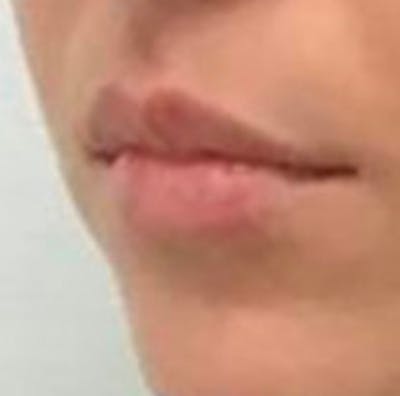 Lip Filler Before & After Gallery - Patient 157309 - Image 4