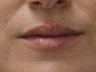 Lip Filler Before & After Gallery - Patient 322144 - Image 1