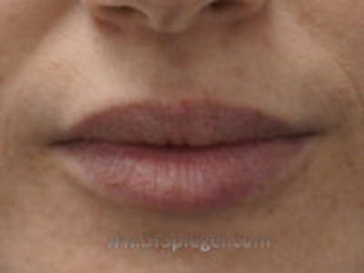 Lip Filler Before & After Gallery - Patient 322144 - Image 2