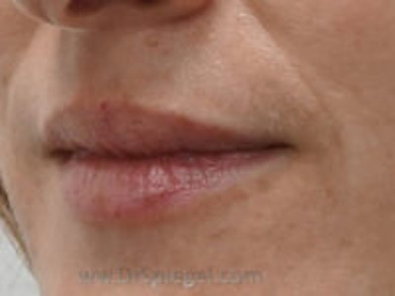 Lip Filler Before & After Gallery - Patient 322144 - Image 3