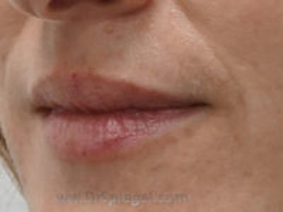 Lip Filler Before & After Gallery - Patient 322144 - Image 3