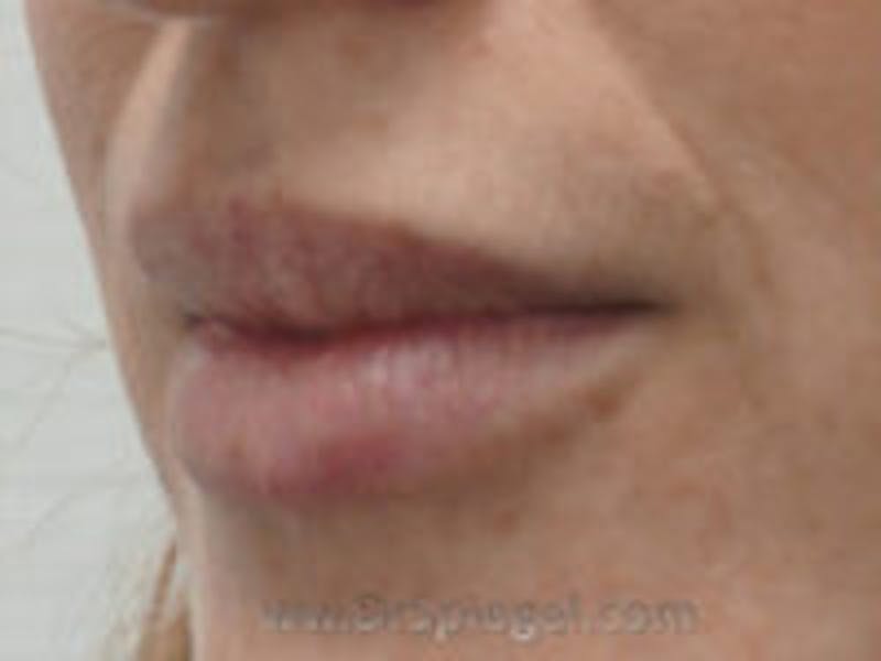 Lip Filler Before & After Gallery - Patient 322144 - Image 4