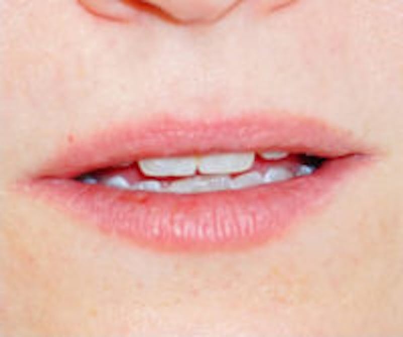 Lip Filler Before & After Gallery - Patient 323919 - Image 1