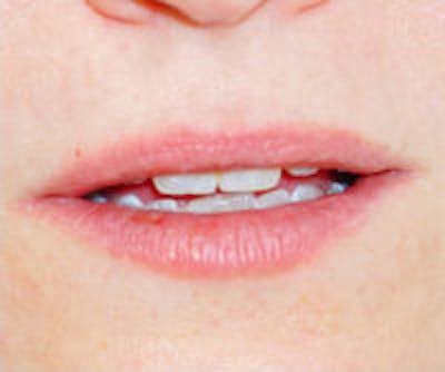 Lip Filler Before & After Gallery - Patient 323919 - Image 1