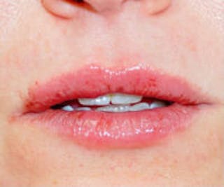Lip Filler Before & After Gallery - Patient 323919 - Image 2