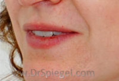 Lip Filler Before & After Gallery - Patient 323919 - Image 3