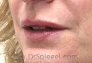 Lip Filler Before & After Gallery - Patient 323919 - Image 4