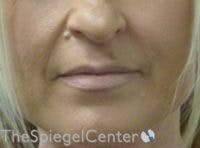Lip Filler Before & After Gallery - Patient 578430 - Image 1