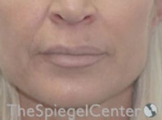 Lip Filler Before & After Gallery - Patient 578430 - Image 2