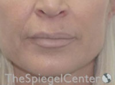 Lip Filler Before & After Gallery - Patient 578430 - Image 2