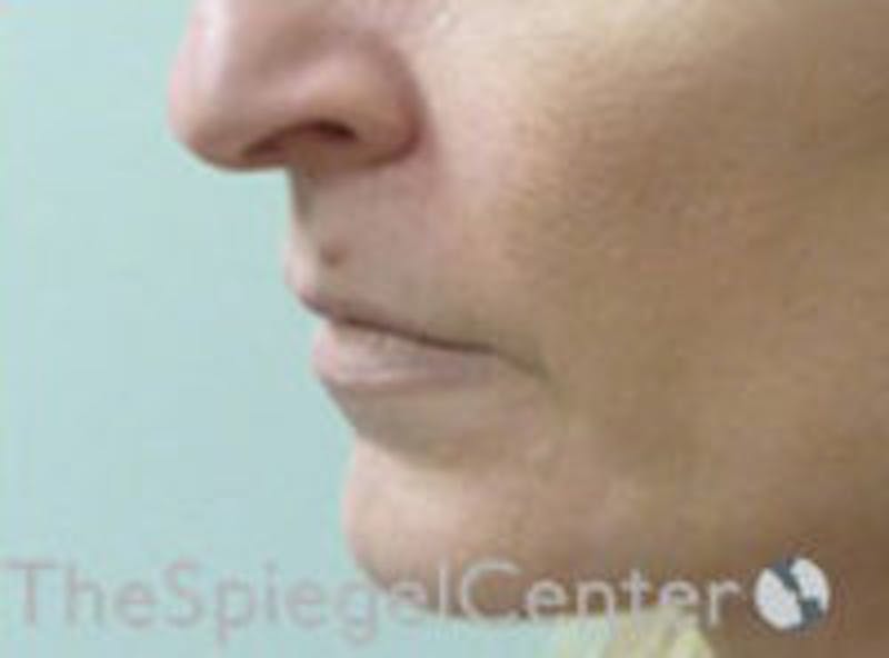 Lip Filler Before & After Gallery - Patient 578430 - Image 3
