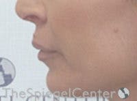Lip Filler Before & After Gallery - Patient 578430 - Image 4