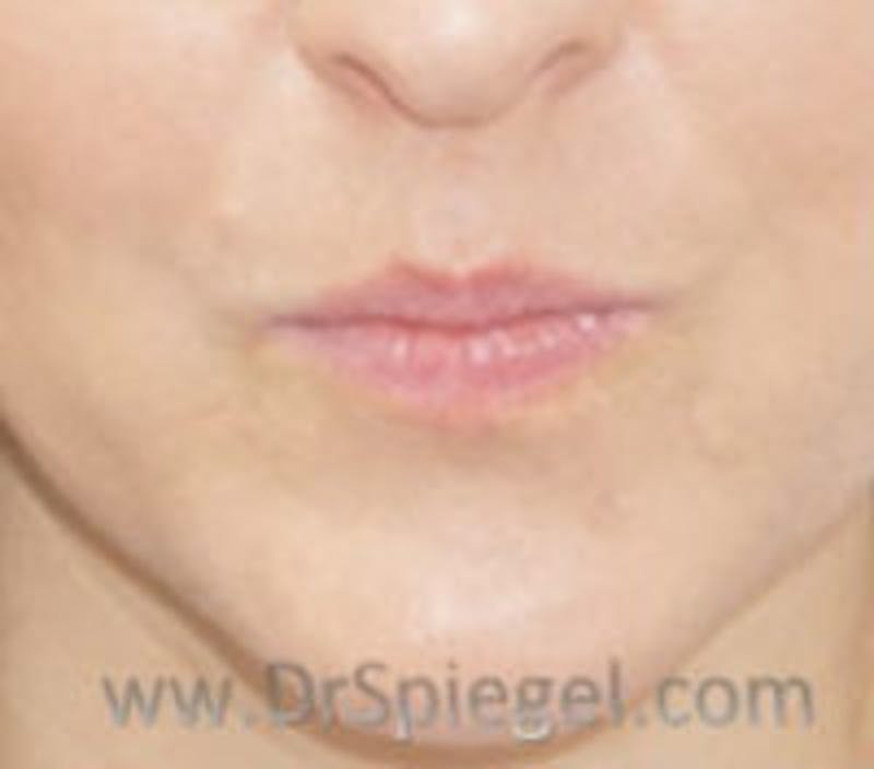 Lip Filler Before & After Gallery - Patient 695508 - Image 1