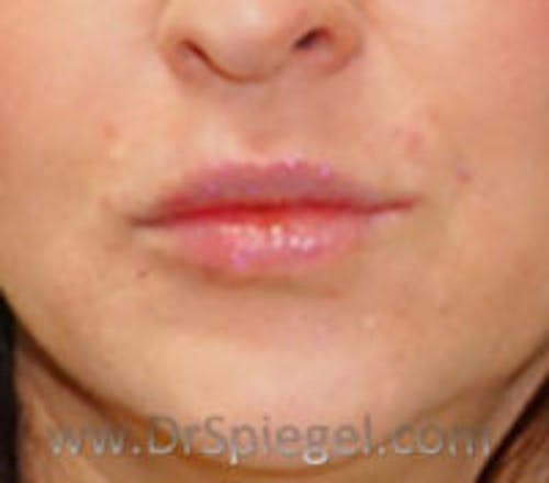 Lip Filler Before & After Gallery - Patient 695508 - Image 2