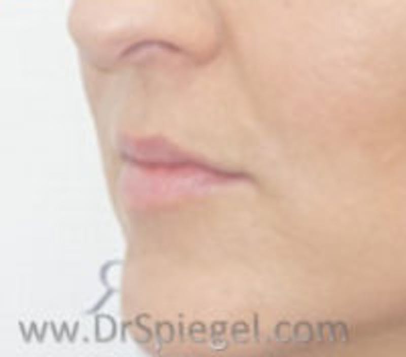 Lip Filler Before & After Gallery - Patient 695508 - Image 3