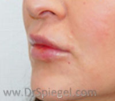 Lip Filler Before & After Gallery - Patient 695508 - Image 4