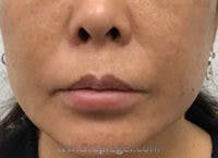 Lip Fillers Before & After Gallery - Patient 244842 - Image 1