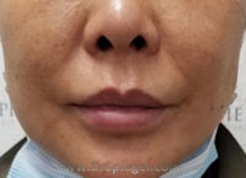 Lip Filler Before & After Gallery - Patient 341908 - Image 2