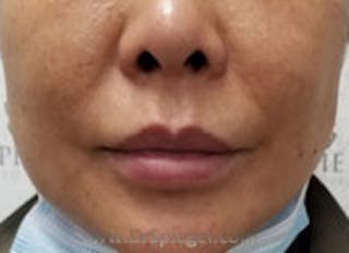 Lip Filler Before & After Gallery - Patient 341908 - Image 2