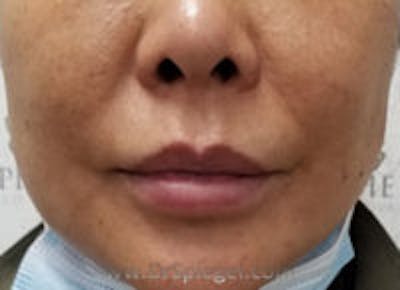 Lip Fillers Before & After Gallery - Patient 244842 - Image 2