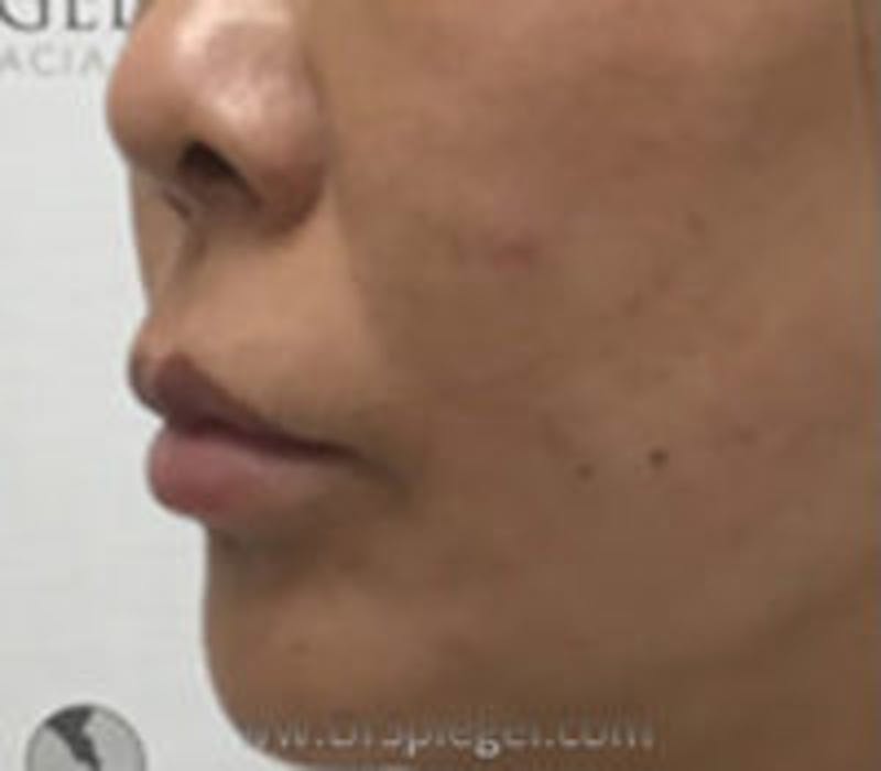 Lip Filler Before & After Gallery - Patient 341908 - Image 4