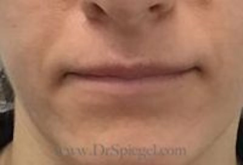 Lip Filler Before & After Gallery - Patient 262592 - Image 1