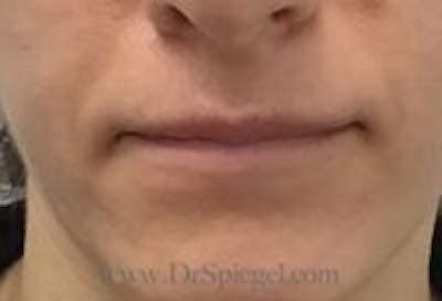 Lip Filler Before & After Gallery - Patient 262592 - Image 1