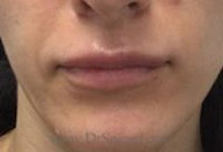 Lip Filler Before & After Gallery - Patient 262592 - Image 2