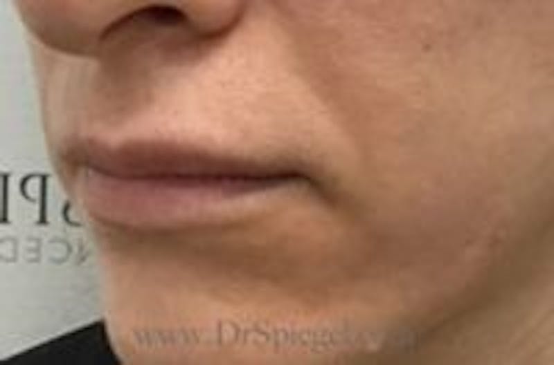 Lip Filler Before & After Gallery - Patient 262592 - Image 3