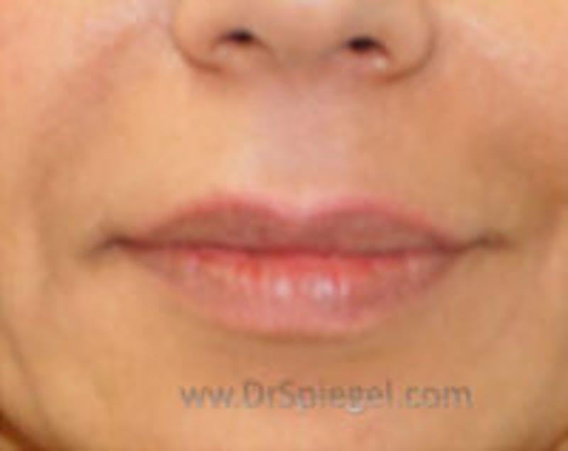 Lip Filler Before & After Gallery - Patient 796240 - Image 1