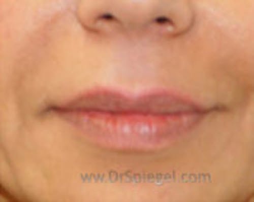 Lip Filler Before & After Gallery - Patient 796240 - Image 1