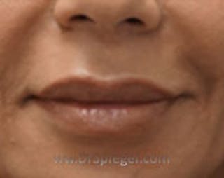 Lip Filler Before & After Gallery - Patient 796240 - Image 2