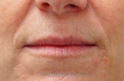 Lip Filler Before & After Gallery - Patient 317276 - Image 1
