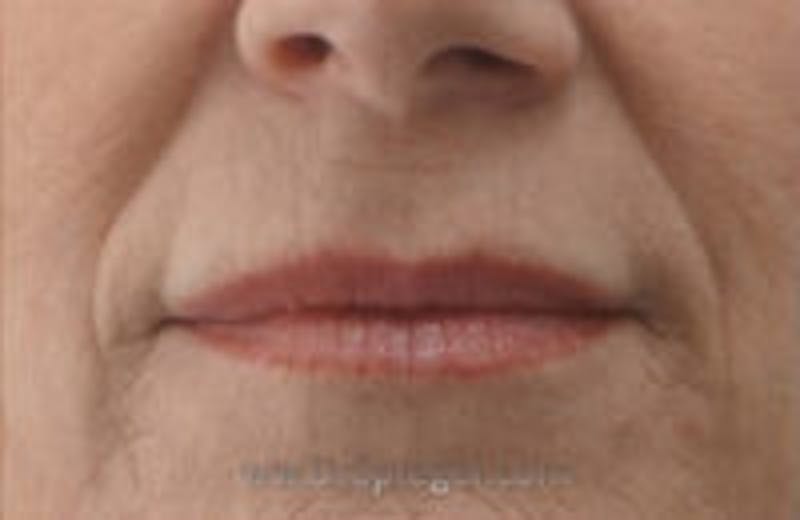 Lip Filler Before & After Gallery - Patient 317276 - Image 2