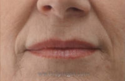 Lip Filler Before & After Gallery - Patient 317276 - Image 2