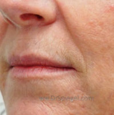 Lip Filler Before & After Gallery - Patient 317276 - Image 3