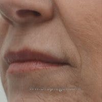 Lip Filler Before & After Gallery - Patient 317276 - Image 4