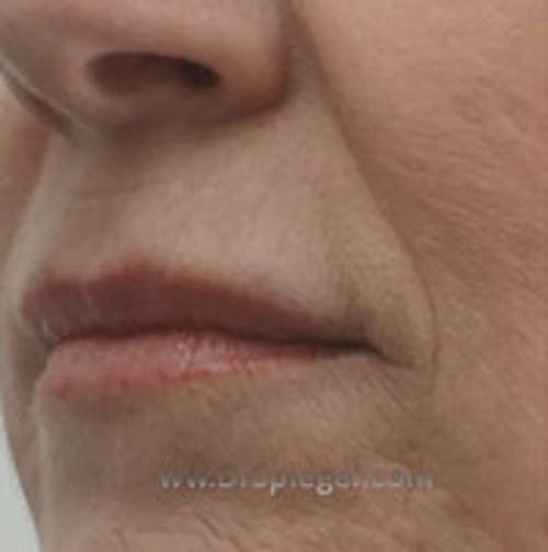 Lip Filler Before & After Gallery - Patient 317276 - Image 4