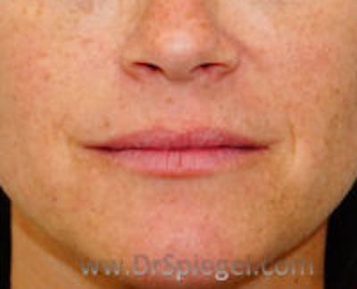 Lip Filler Before & After Gallery - Patient 113338 - Image 1