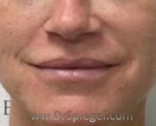 Lip Filler Before & After Gallery - Patient 113338 - Image 2