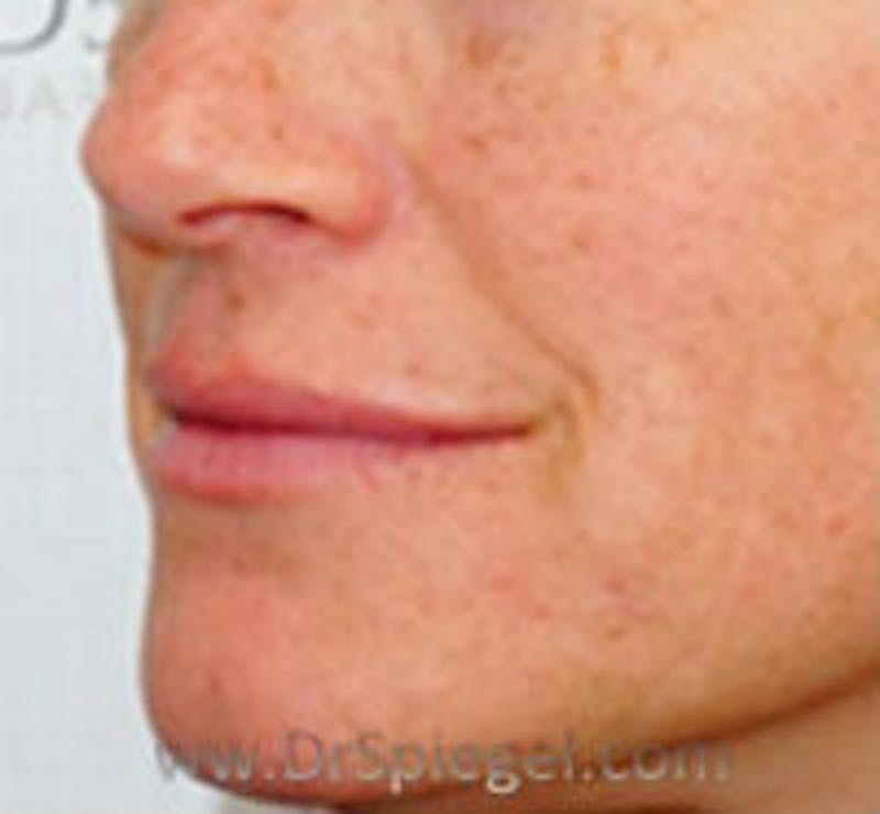 Lip Filler Before & After Gallery - Patient 113338 - Image 3